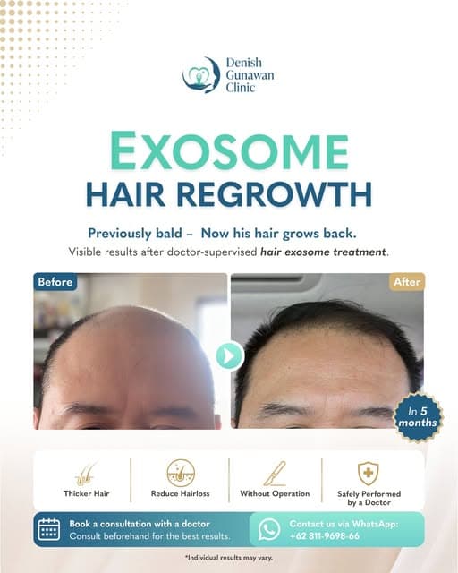 Exosome hair regrowth results